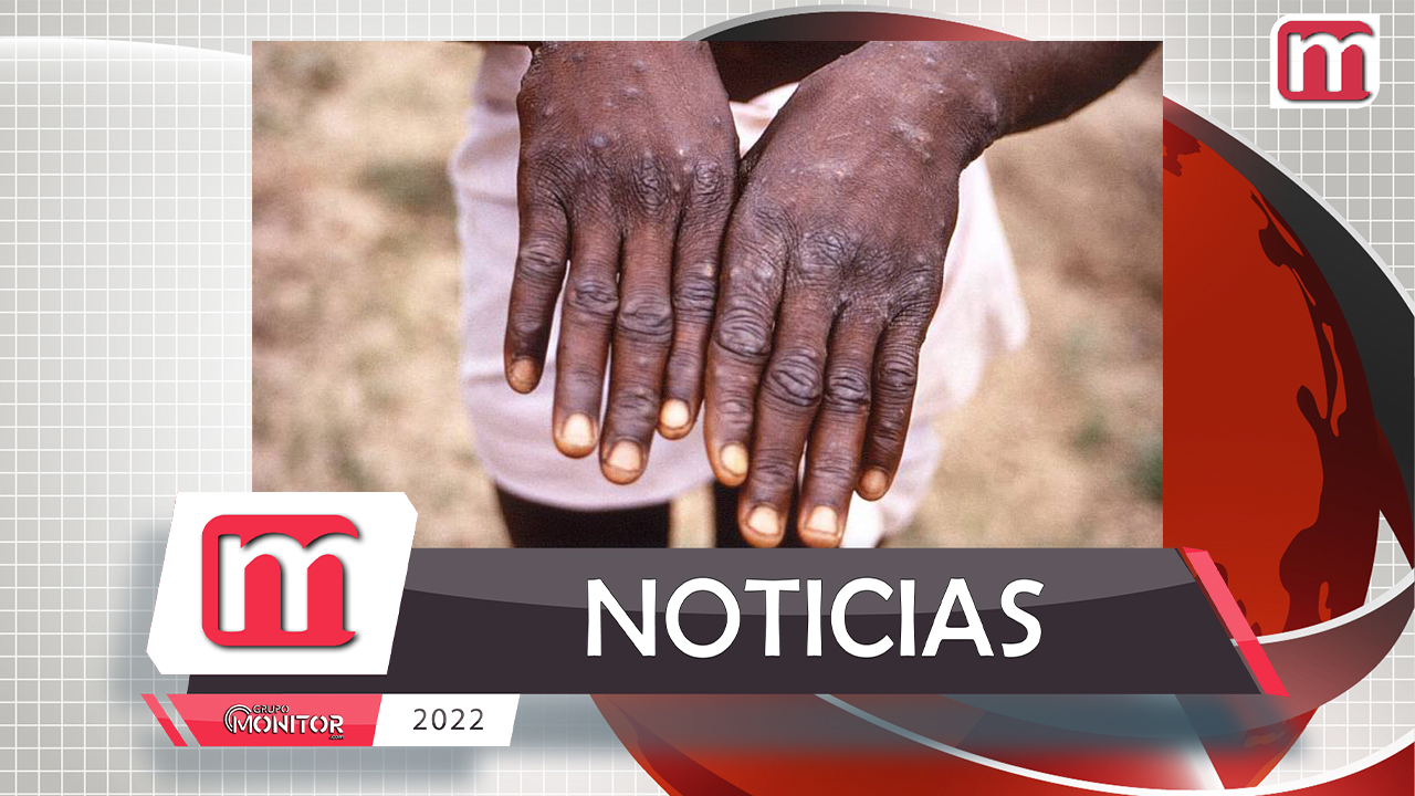 México reporta 5 casos de viruela del mono; descarta pandemia