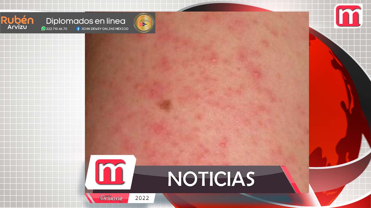 La valoración médica es relevante para cualquier tipo de dermatitis