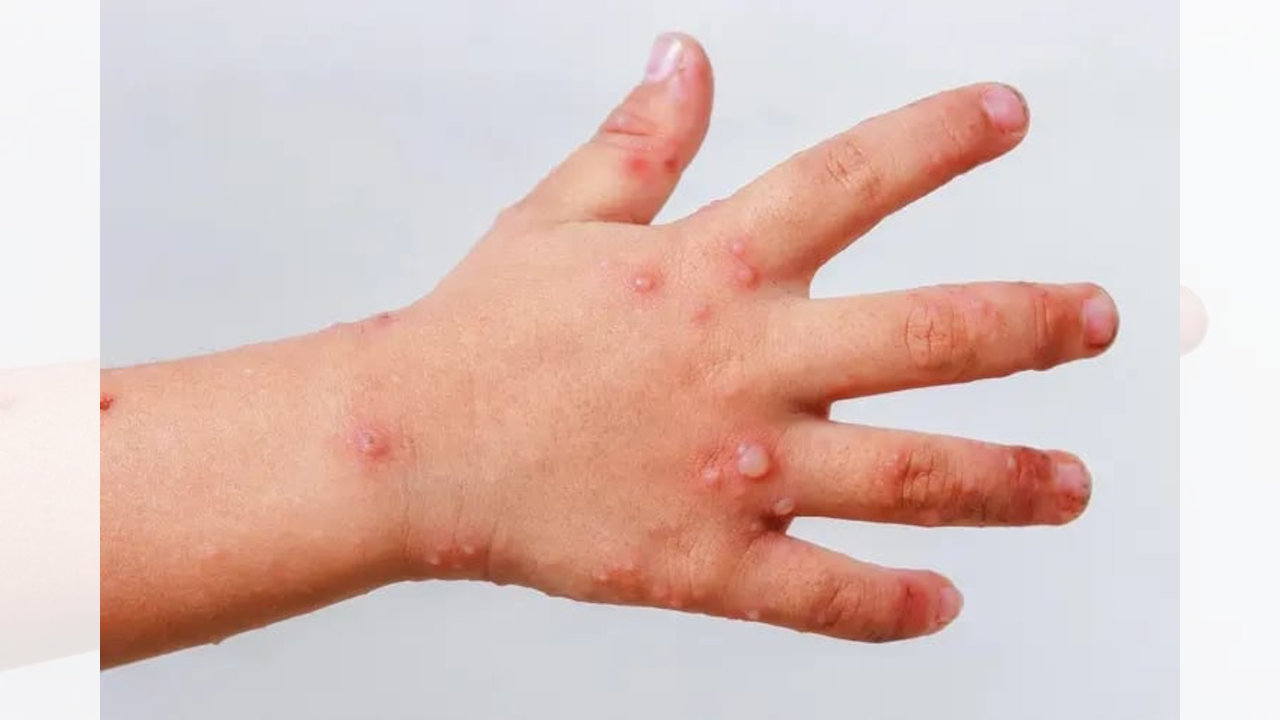 Gobierno Municipal de Zacatelco anuncia medidas preventivas contra el virus Coxsackie en niñas y niños